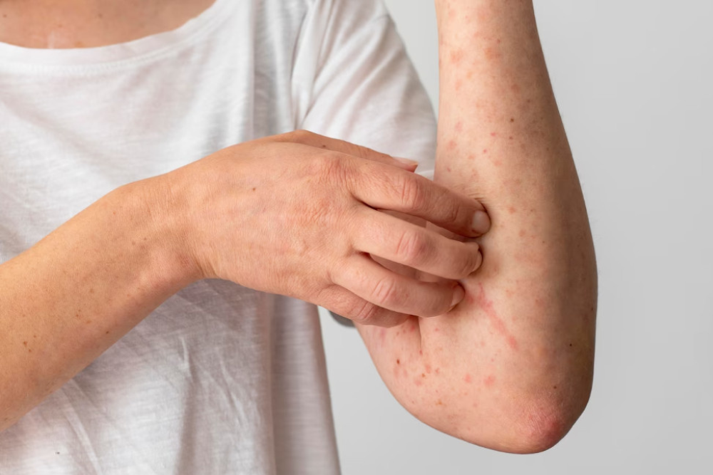 Dia Mundial da Alergia: saiba quais as mais comuns e como diagnosticá-las Dia Mundial da Alergia: saiba quais as mais comuns e como diagnosticá-las