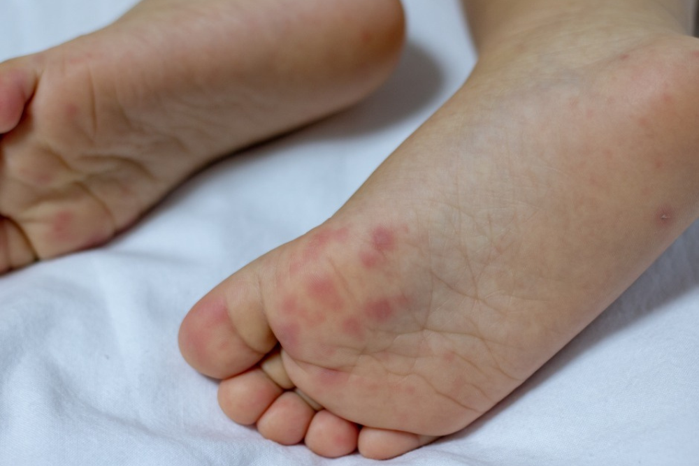 Saiba o que &eacute; e como prevenir a S&iacute;ndrome M&atilde;o-P&eacute;-Boca
